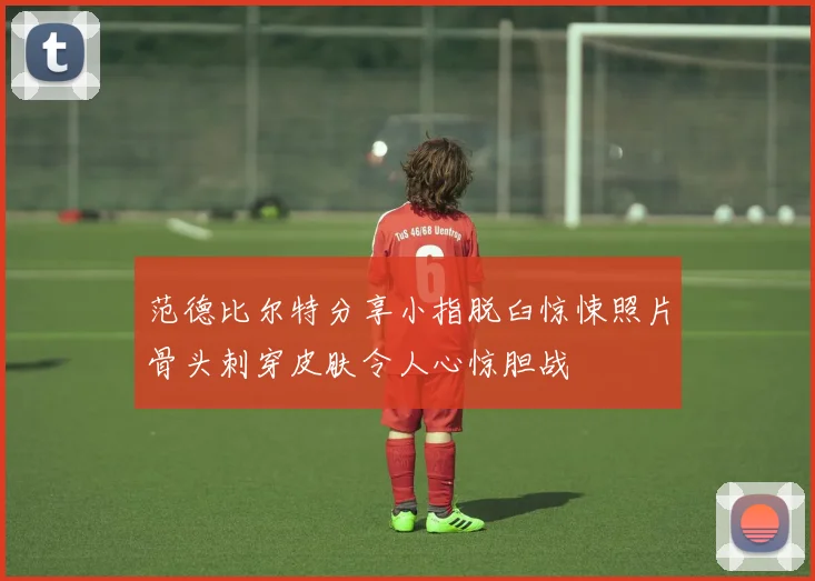 范德比尔特分享小指脱臼惊悚照片骨头刺穿皮肤令人心惊胆战